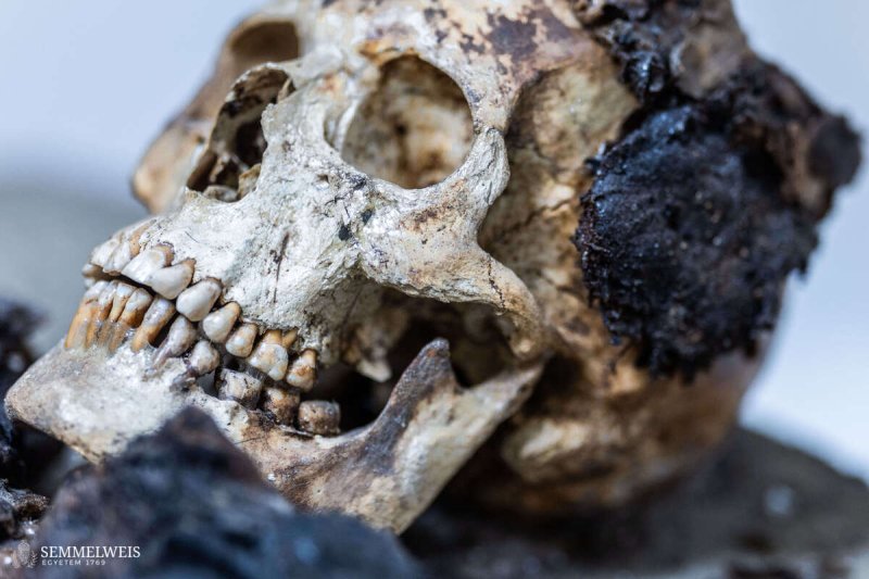 Budapesten tal&aacute;lt r&oacute;mai m&uacute;mi&aacute;n v&eacute;geztek CT-vizsg&aacute;latot